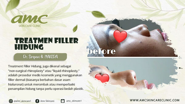 Treatmen Filler Hidung